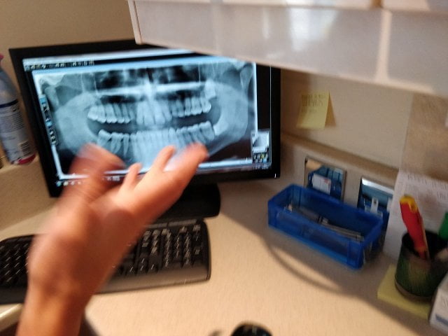 X-ray of teeth on a computer monitor.