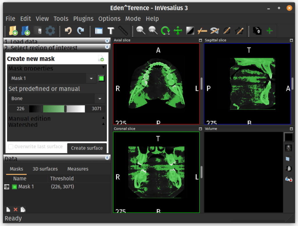 InVesalius showing sliced data imported.