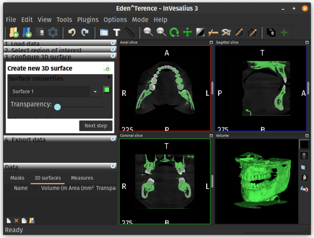 InVesalius showing sliced surface in 3D.